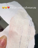 چسب جوش سرسیاه بینی لانبنا کاسه ای LANBENA اصل